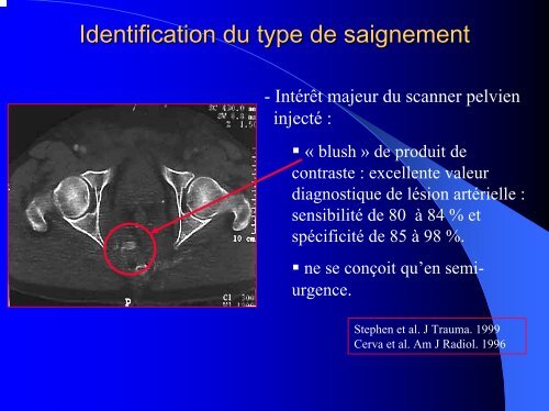 Prise en charge des traumatismes du bassin sévères