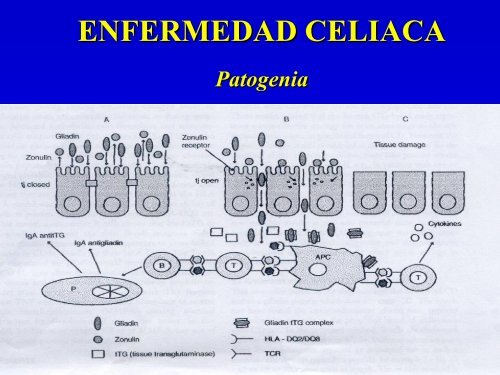 ENFERMEDAD CELIACA.pdf