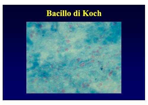 Tubercolosi primaria - FacoltÃ  di Medicina e Chirurgia