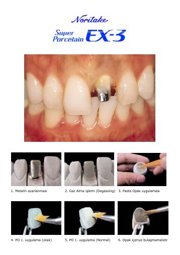 EX-3 Uygulama BroÅÃ¼rÃ¼ - Turkuaz Dental