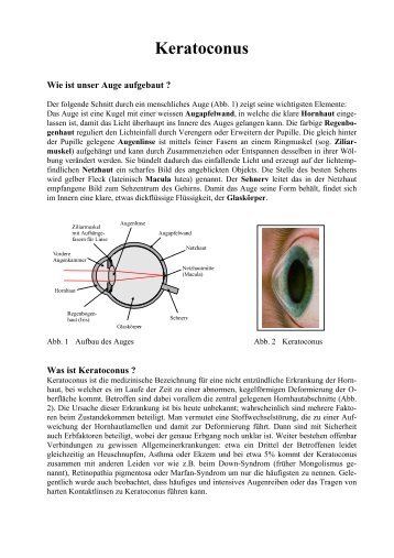 Keratoconus - Augenärzte Thun und Umgebung