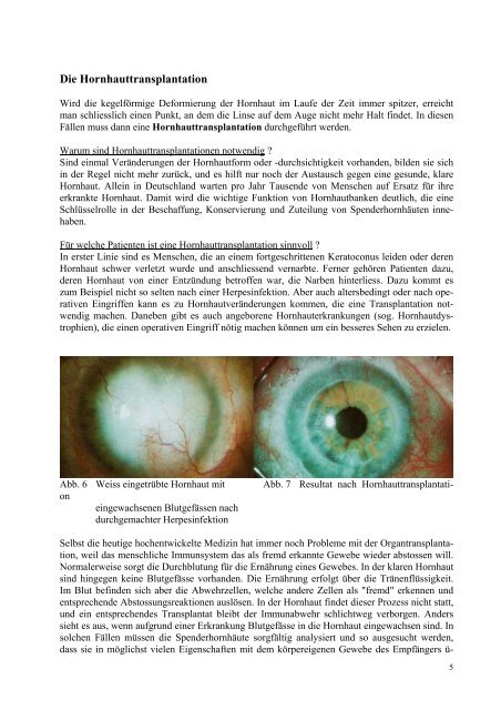 Keratoconus - Augenärzte Thun und Umgebung