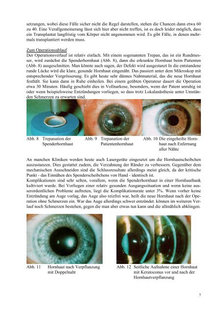 Keratoconus - Augenärzte Thun und Umgebung