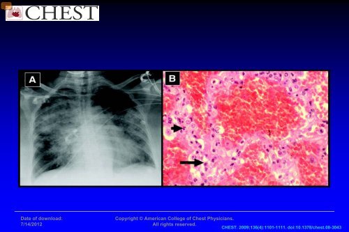 SÃ­ndromes vasculÃ­ticos riÃ±Ã³n - pulmÃ³n y hemorragia pulmonar mÃ©dica