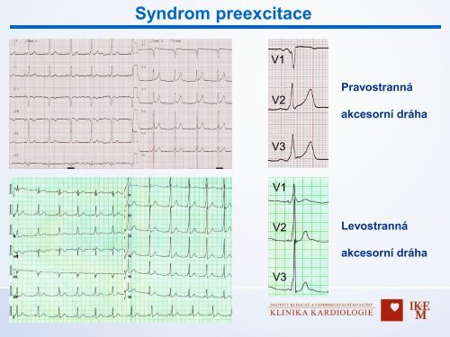 Diagnostika v arytmologii â MUDr. Dan Wichterle, Ph.D., IKEM, Praha