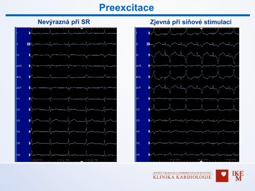 Diagnostika v arytmologii â MUDr. Dan Wichterle, Ph.D., IKEM, Praha