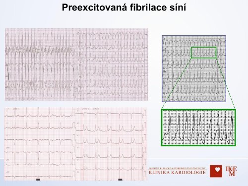 Diagnostika v arytmologii â MUDr. Dan Wichterle, Ph.D., IKEM, Praha