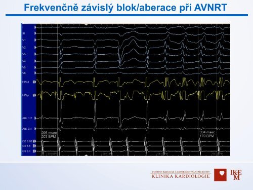 Diagnostika v arytmologii â MUDr. Dan Wichterle, Ph.D., IKEM, Praha