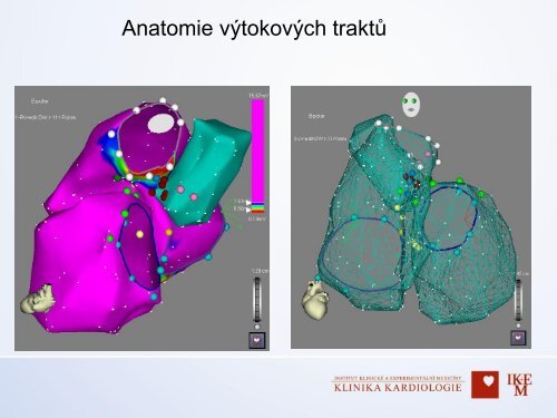 Diagnostika v arytmologii â MUDr. Dan Wichterle, Ph.D., IKEM, Praha