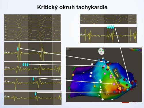 Diagnostika v arytmologii â MUDr. Dan Wichterle, Ph.D., IKEM, Praha