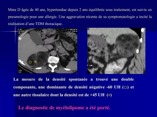 MASSES SURRENALIENNES INHABITUELLES