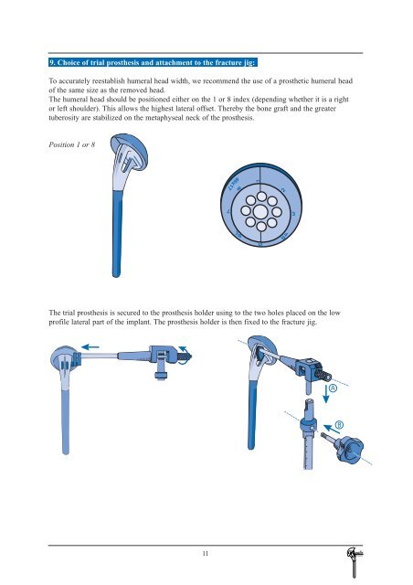 Tornier Fracture Surgical Technique