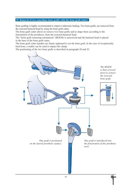 Tornier Fracture Surgical Technique