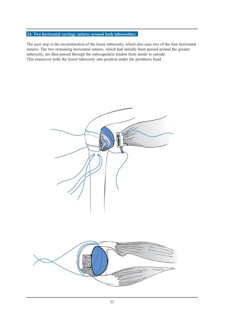 Tornier Fracture Surgical Technique