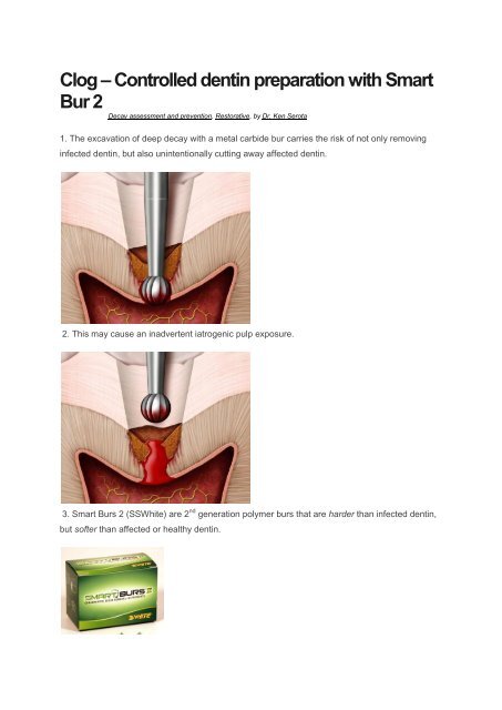 Clog A Controlled Dentin Preparation With Smart De Vos Endo Bv