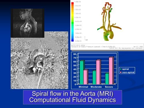 Spiral Laminar Flow - SUPA