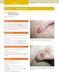 163 BASAL CELL CARCINOMA SECTION 12 SKIN CANCER