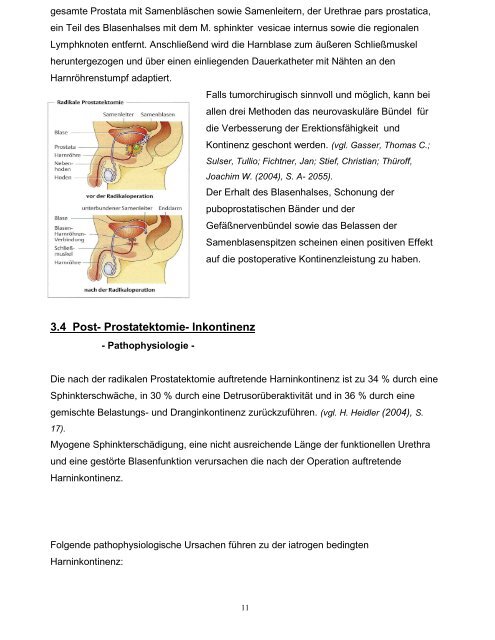 Inkontinenz Radikaler Prostatektomie - ganeo