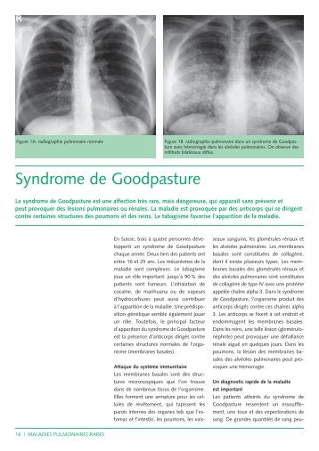 Syndrome de Goodpasture (143Kb) - CHUV