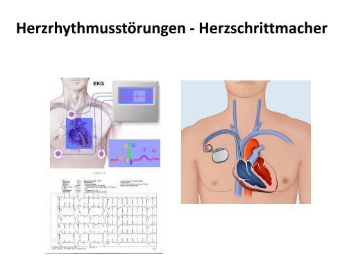 Myotone Dystrophie (PDF 2 MB)