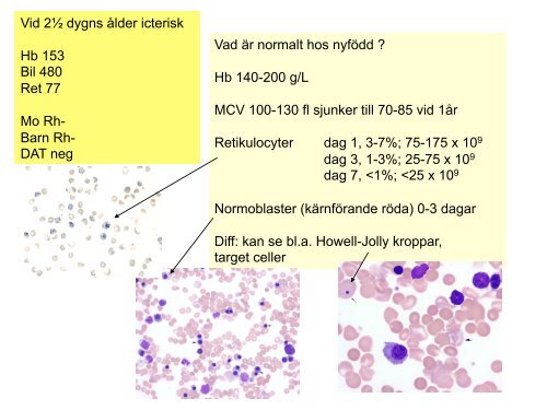 Neonatal anemi - Ulf TedgÃ¥rd - BLF