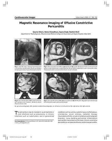 Magnetic Resonance Imaging of Effusive Constrictive Pericarditis