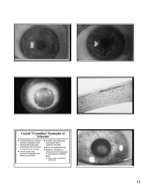 The Genetic Mysteries of the Corneal Dystrophies The Genetic ...