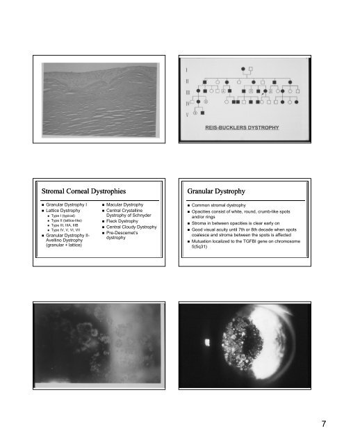 The Genetic Mysteries of the Corneal Dystrophies The Genetic ...