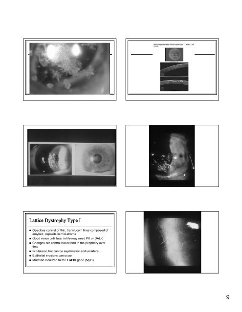 The Genetic Mysteries of the Corneal Dystrophies The Genetic ...