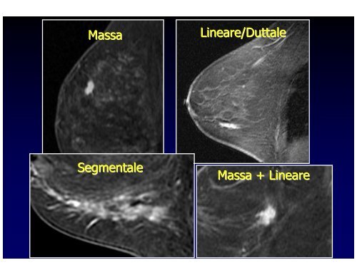 RM della mammella e Neoplasie in situ - Aicod