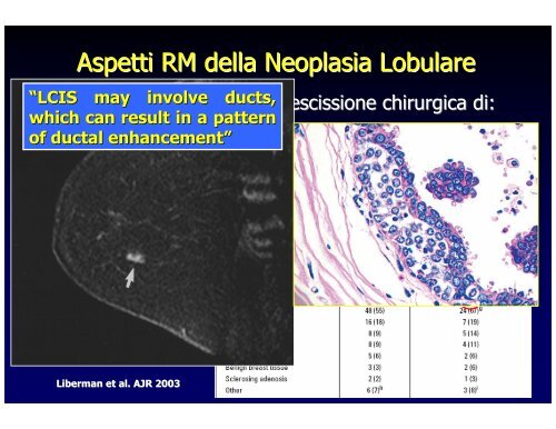 RM della mammella e Neoplasie in situ - Aicod