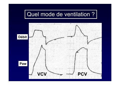 Ventilation du SDRA rÃ©glage et surveillance - SRLF