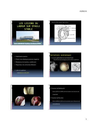 Les lésions du labrum sur épaule stable - X. Cassagnaud