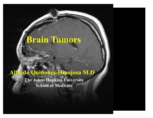 Motor strip glioblastoma multiforme Erotic pictures of bond girls
