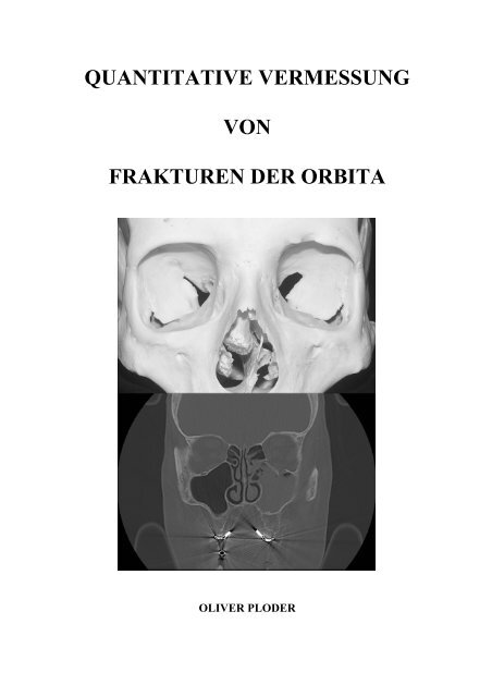 QUANTITATIVE VERMESSUNG VON FRAKTUREN DER ORBITA