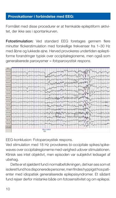 EEG og Epilepsi - Dansk Psykiatrisk Selskab