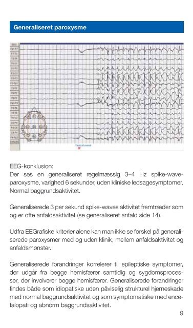 EEG og Epilepsi - Dansk Psykiatrisk Selskab