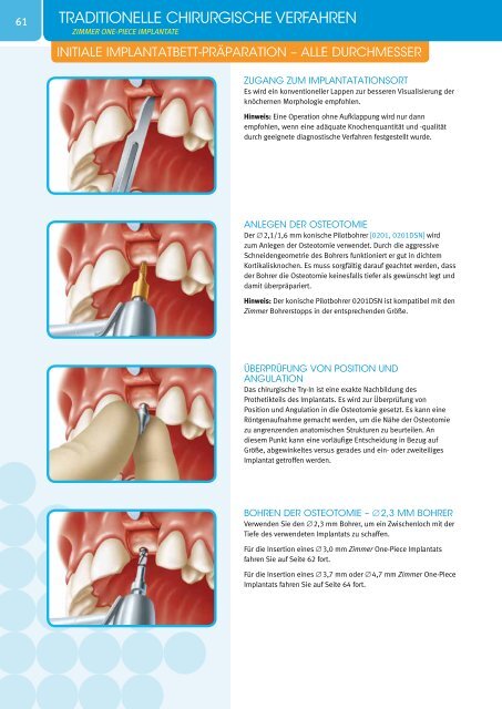 Tapered Screw-VentÃ‚Â® Implantatsystem - Zimmer Dental