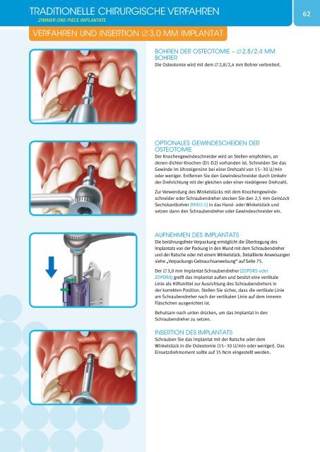 Tapered Screw-VentÃ‚Â® Implantatsystem - Zimmer Dental