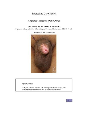 Interesting Case Series Acquired Absence of the Penis - ePlasty