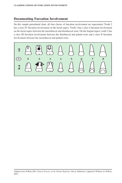 Furcation Involvement Charting