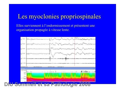 Comportements moteurs anormaux au cours du sommeil - SPLF