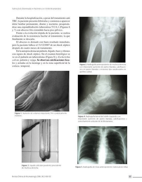 Tuberculosis Diseminada en Pacientes con Artritis ReumatoÃ­dea