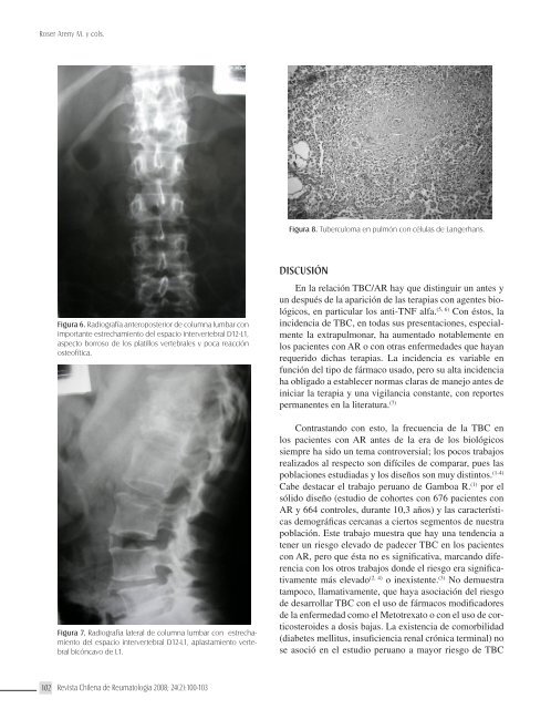 Tuberculosis Diseminada en Pacientes con Artritis ReumatoÃ­dea