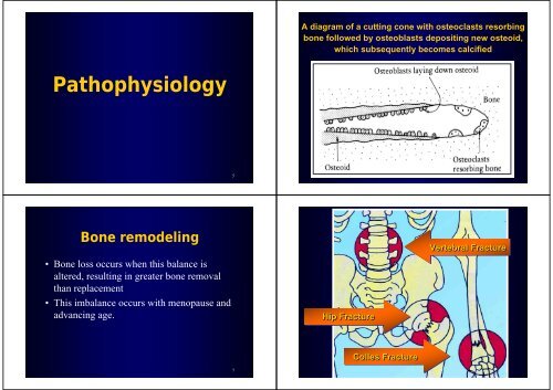 Osteoporosis - Hong Kong Physiotherapy Association