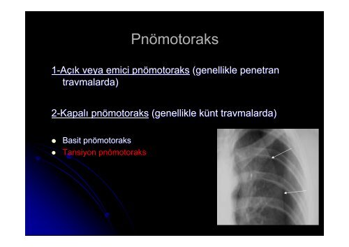 Penetran Toraks TravmalarÄ±