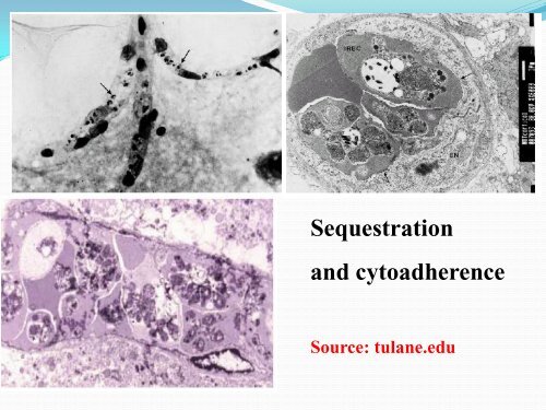 The pathology of malaria