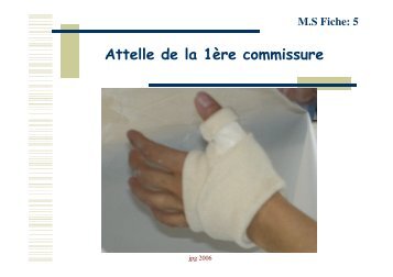 Attelle de la 1Ã¨re commissure - COLMU