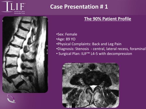 ILIF Interlaminar Lumbar Instrumented Fusion