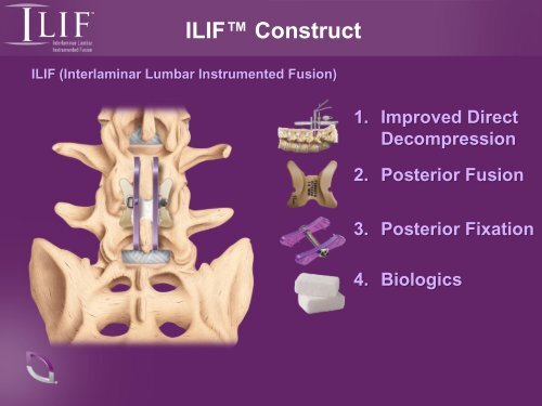 ILIF Interlaminar Lumbar Instrumented Fusion